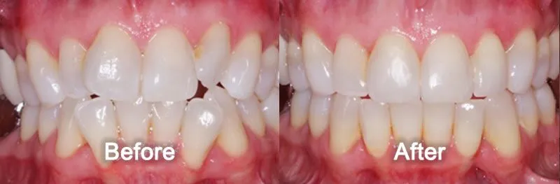 Braces